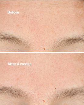 CLARIFYING DO-OVER PEEL 1