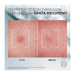 DERMA CONTROL S.O.S. PIMPLE PASTE 5