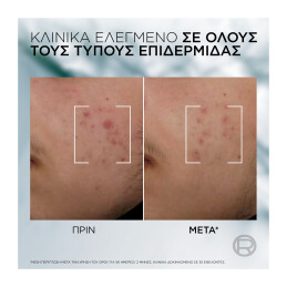 DERMA CONTROL ΟΡΟΣ ΚΑΤΑ ΤΩΝ ΑΤΕΛΕΙΩΝ ΜΕ ΝΙΑΣΙΝΑΜΙΔΗ 3