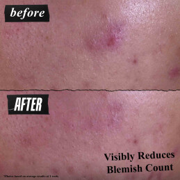 GENTLY EFFECTIVE BLEMISH-TARGETING CLEANSING PASTE 2