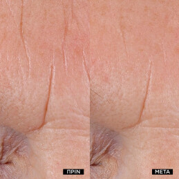 RÉNERGIE NANO-RESURFACER | 400 BOOSTER 3