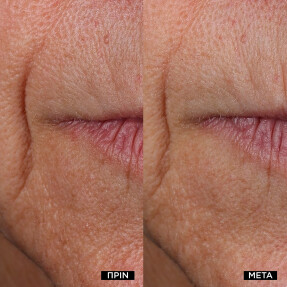 RÉNERGIE NANO-RESURFACER | 400 BOOSTER