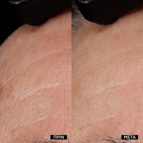 RÉNERGIE NANO-RESURFACER | 400 BOOSTER