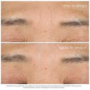 CAPTURE TOTALE HYALUSHOT WRINKLE CORRECTOR | 15ml