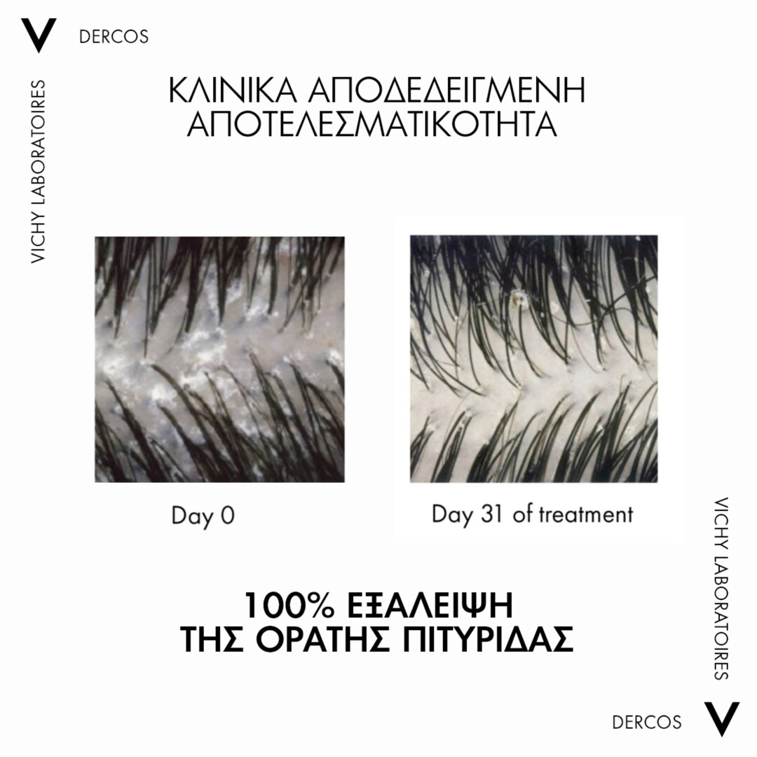 DERCOS ANTI-DANDRUFF DS 2ΣΕ1 ΣΑΜΠΟΥΑΝ & CONDITIONER ΚΑΤΑ ΤΗΣ ΞΗΡΟΔΕΡΜΙΑΣ, ΤΗΣ ΠΙΤΥΡΙΔΑΣ ΚΑΙ ΤΟΥ ΚΝΗΣΜΟΥ 6