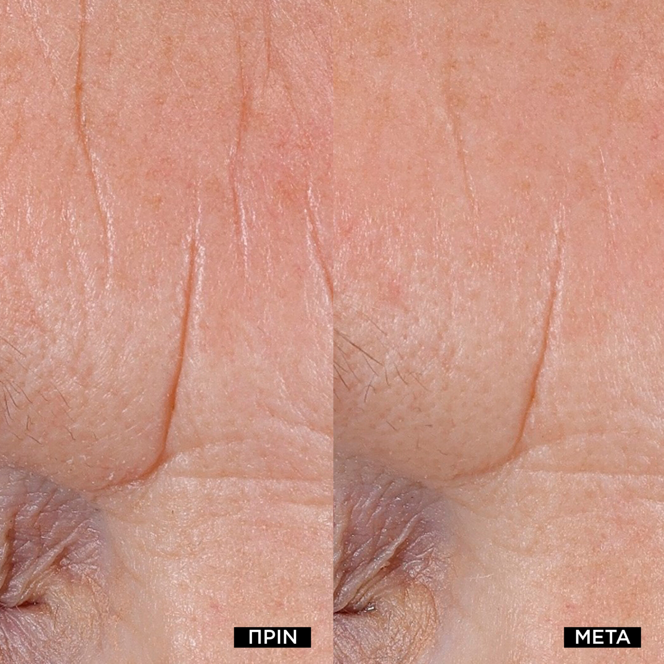 RÉNERGIE NANO-RESURFACER | 400 BOOSTER 3