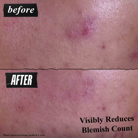 GENTLY EFFECTIVE BLEMISH-TARGETING CLEANSING PASTE 2