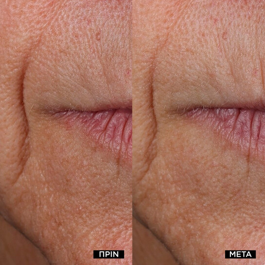 RÉNERGIE NANO-RESURFACER | 400 BOOSTER 4